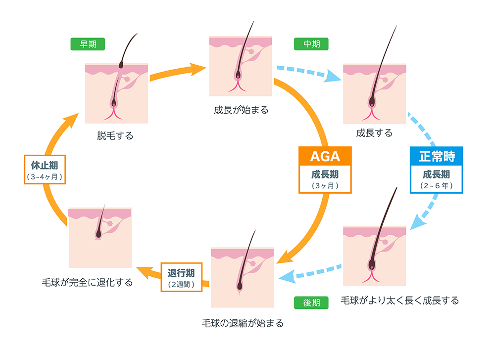 ヘアサイクルの乱れ