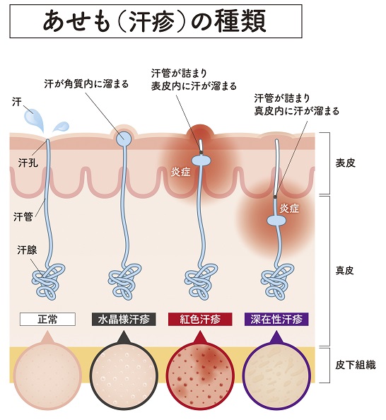 あせもとは？症状や汗かぶれとの違い