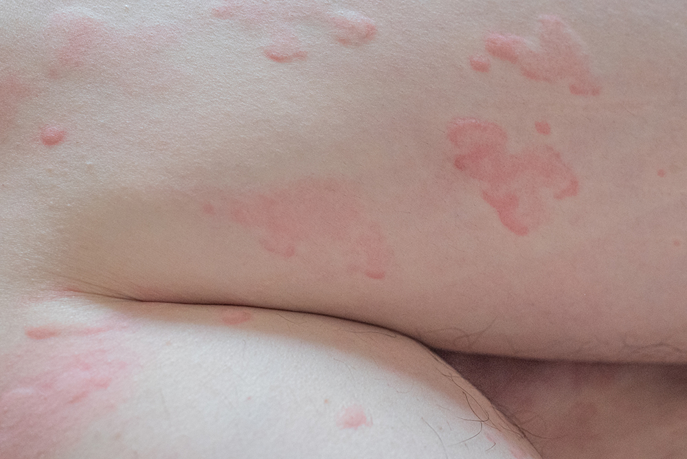 かゆい・発疹…蕁麻疹（じんましん）の症状とは