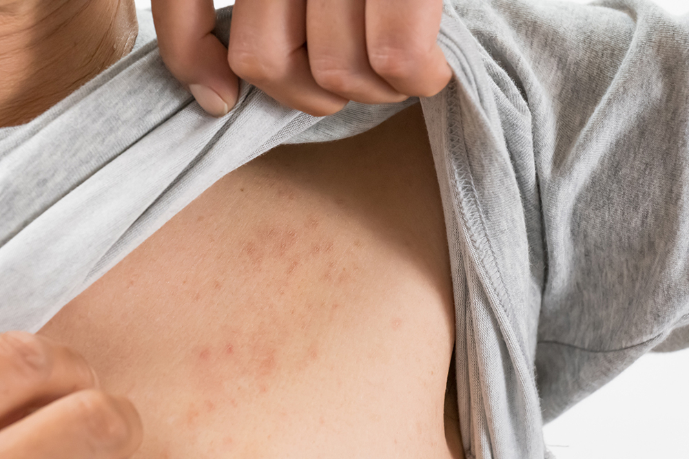 蕁麻疹と湿疹の違い