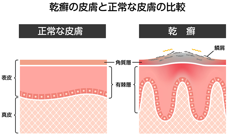 乾癬とは