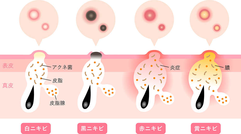 ニキビの種類と対策